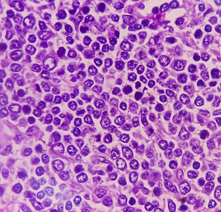 mcl b zellen lymphknoten mikroskop